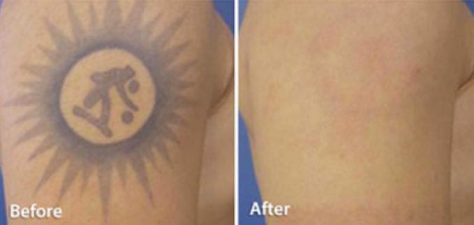 Tattoo Removal Machine | The Global Beauty Group