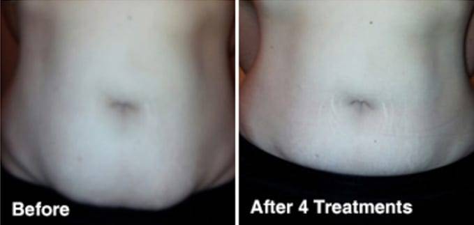 Fat Cavitation Results - The Global Beauty Group