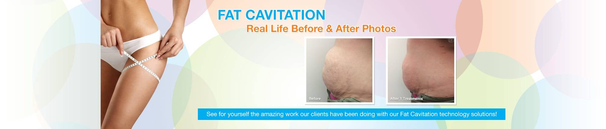 fat cavitation results the global beauty group fat cavitation results the global beauty group