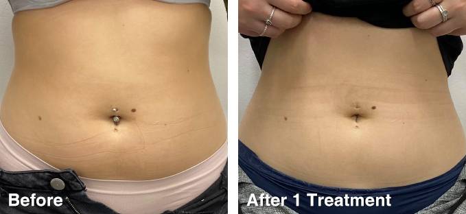 Criocuum Cryo Body Contouring Machine | The Global Beauty Group
