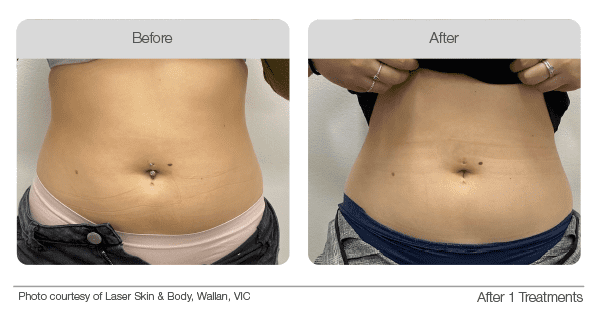 Cryolipolysis-Before-&-After-07 - The Global Beauty Group