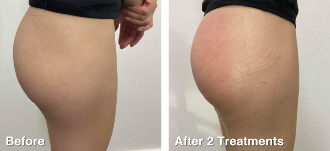 BEFORE & AFTERS - BODY SCULPTING – BEAUTYMEDIX