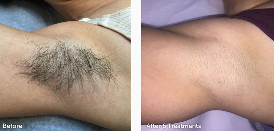 before-after-hair-removal-new