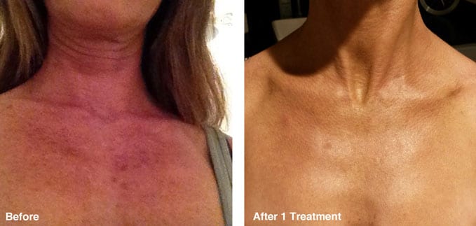 before-after-skin-tone-correction4 – The Global Beauty Group