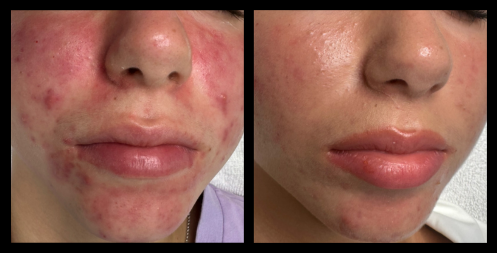 Before and after results showing visible skin improvement after 6 Carbon Facial and Blue Light LED treatments at Exquise Skin Boutique – effective solution for acne, enlarged pores, and oily skin.