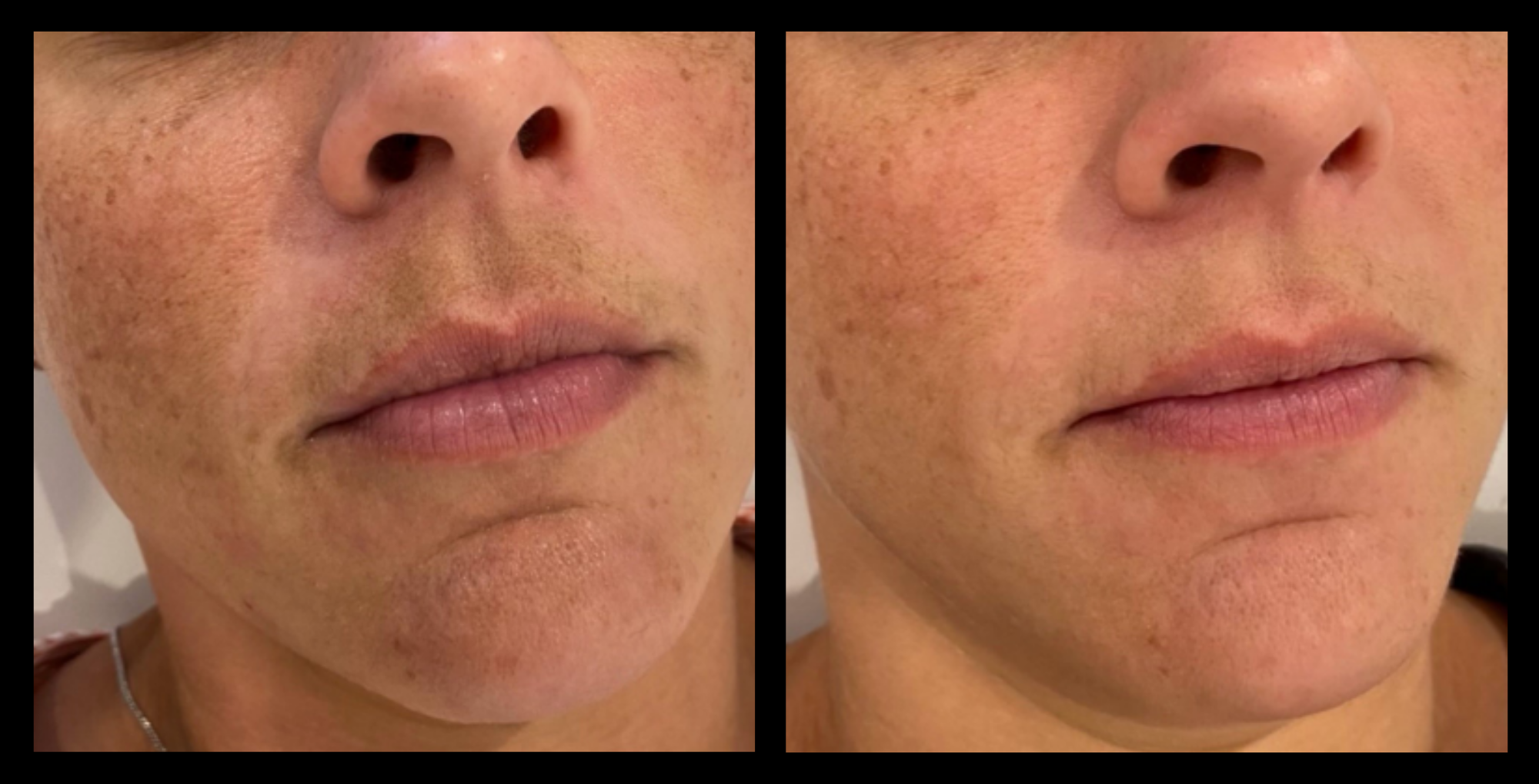 Carbon Facial before and after – 2-session results showing refined pores, brighter skin, and even tone. Advanced Carbon Laser Facial treatment by Michaux Total Body Care, Glen Waverley, VIC – leading skincare clinic in Melbourne.