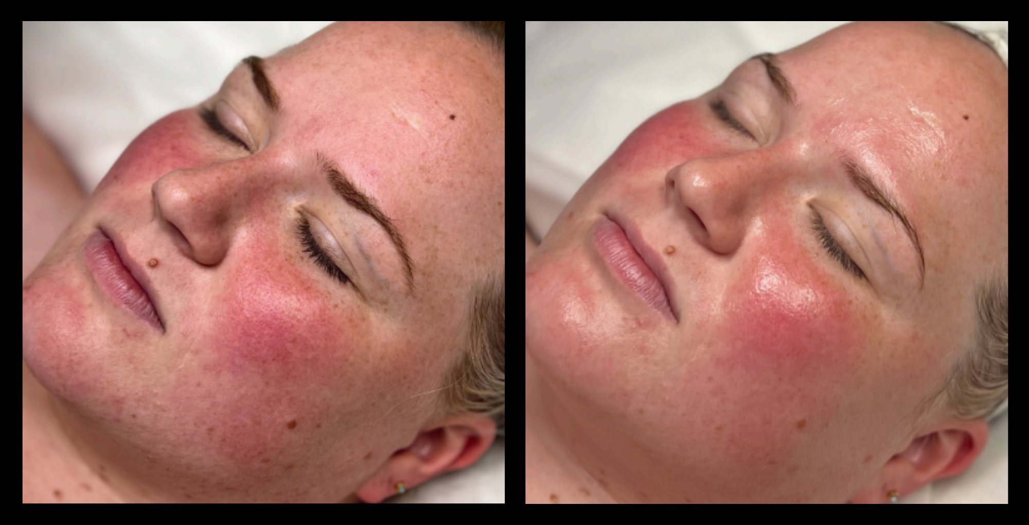 Carbon Facial before and after results after 1 treatment at Tranquil Therapy Beauty + Laser, Raymond Terrace NSW – clearer skin, reduced congestion, and improved overall complexion.