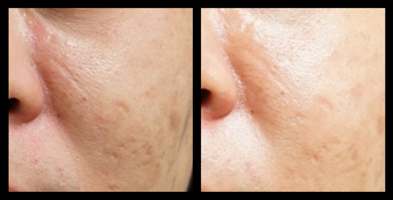 Fractional RF Skin Resurfacing. After 1 Treatment. Photo Courtesy of Asterasys.
