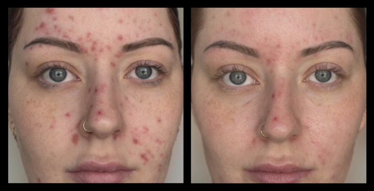 Before and after image showing the results of IPL acne management after 6 treatments, with visibly clearer skin and reduced inflammation. Treatment performed by Beyond Beauty Co, NSW.