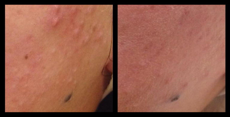 Before and after results from IPL Acne Management treatment on the cheek, showing a visible reduction in active breakouts and post-inflammatory redness. Skin appears clearer, smoother, and more evenly toned following a course of treatment.