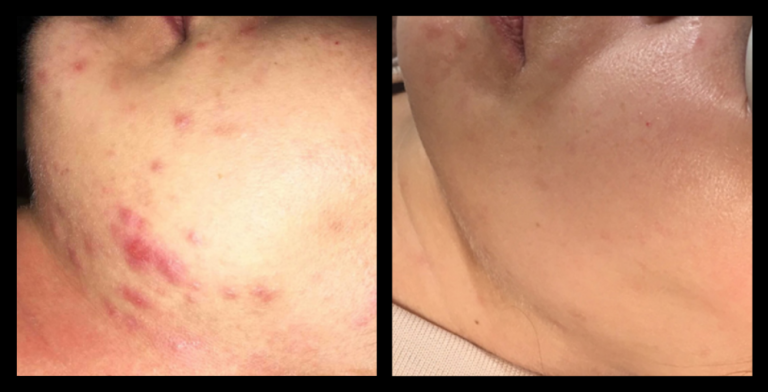 Before and after results of IPL acne treatment after 3 sessions, showing significant reduction in active acne and redness. IPL acne therapy performed by Glow Skin + Body, Doveton, VIC.