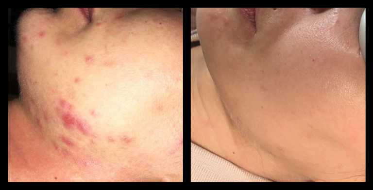 Before and after results from IPL Acne Management treatment on the cheek and chin, showing a dramatic reduction in inflamed lesions, cystic breakouts, and post-inflammatory erythema. Skin appears significantly clearer, with smoother texture and a more even tone following a course of treatment.