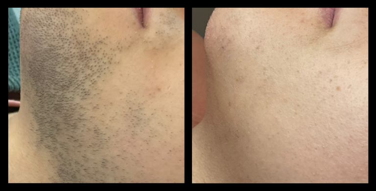 Before and after IPL permanent hair removal results after 8 treatments, showing significant reduction in hair growth. Results achieved by Complete Skincare and Electrolysis, Canterbury, VIC.