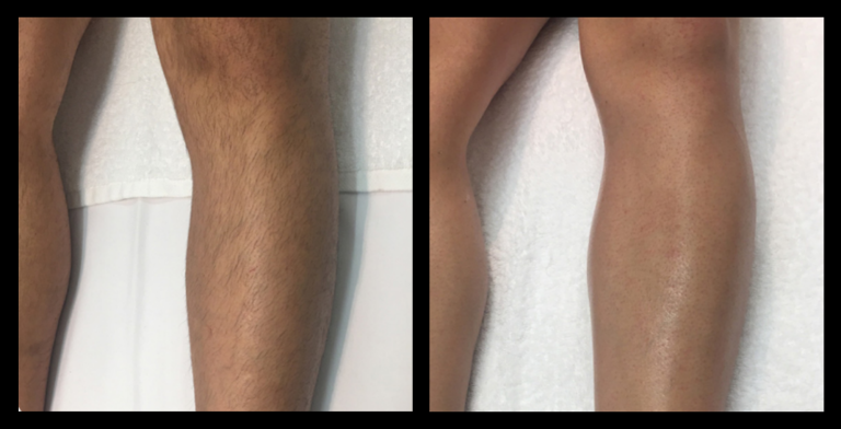 Before and after IPL permanent hair removal results on legs after 5 treatments, highlighting visible hair reduction and smoother skin. Results courtesy of H's Place Hair Skin and Beauty, Melton, VIC.