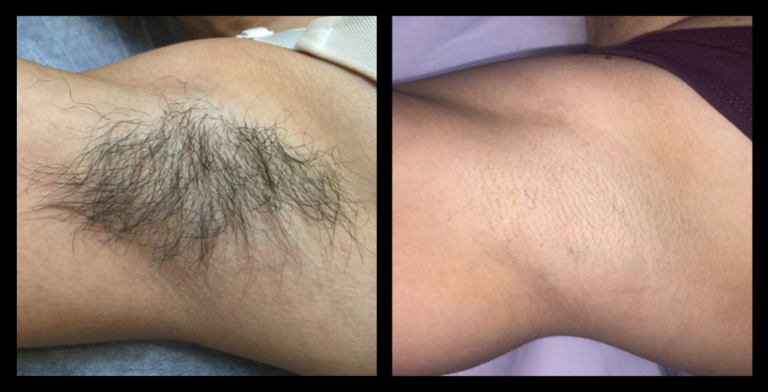 Underarm IPL permanent hair removal before and after results shown after 6 treatments, featuring significant hair reduction and smoother skin. Image courtesy of The Global Beauty Group.