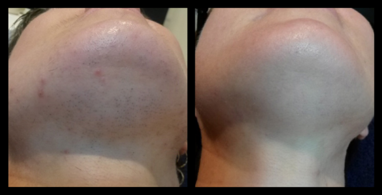 Before and after results of IPL permanent hair removal after 6 treatments, demonstrating visible hair reduction and smoother skin texture. Image courtesy of Ella Baché, Batemans Bay, NSW.