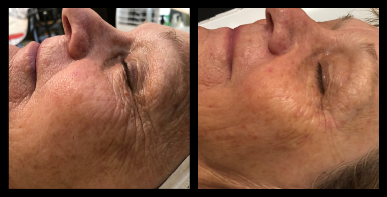 Before and after results following 2 sessions of IPL Photo Rejuvenation, Carbon Facial, and Sonophoresis at Glow Skin + Body, Doveton VIC – visibly brighter, clearer, and more refined skin tone and texture.