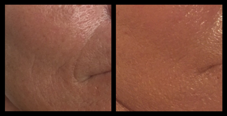 IPL Photo Rejuvenation before and after results showing smoother skin texture, reduced redness, and overall rejuvenation after 3 treatments. Courtesy of Boutique of Cosmetic Dermatology, Varsity Lakes, QLD.