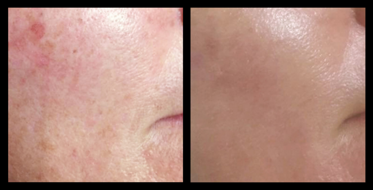 IPL Photo Rejuvenation before and after results showing visibly brighter skin, reduced pigmentation, and improved skin texture after 2 treatments. Courtesy of Boutique of Cosmetic Dermatology, Varsity Lakes, QLD.