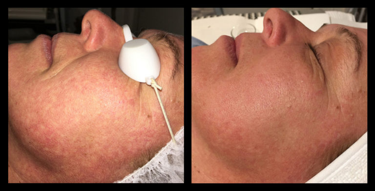 IPL Photo Rejuvenation before and after image showing reduced redness, smoother skin tone, and enhanced complexion after 2 treatments. Courtesy of Glow Skin + Body, Doveton, VIC.