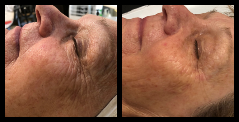 Before and after IPL Photo Rejuvenation results after 2 treatments showing visibly reduced pigmentation and improved skin clarity. Image courtesy of Glow Skin + Body, Doveton, VIC.