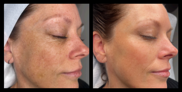 Close-up image showing visible skin improvement after two IPL Pigmentation Correction treatments. Pigmentation is significantly reduced, revealing a clearer, more even-toned complexion. Treatment performed by Zenyu Skin and Beauty, Mornington, VIC.