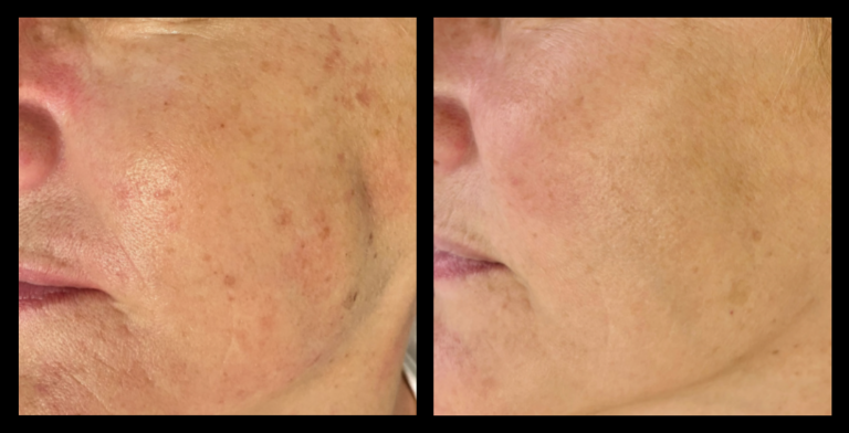 Before and after results of IPL Pigmentation Correction after 2 treatments, showing reduced pigmentation and clearer skin. Image courtesy of Beauty Body and Balance, Stockton, NSW.