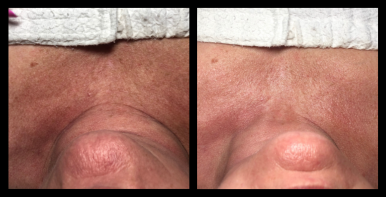 Before and after results of IPL Pigmentation Correction after 1 treatment, showing visible reduction in pigmentation. Image courtesy of Beauty Bar Byford, Byford, WA.