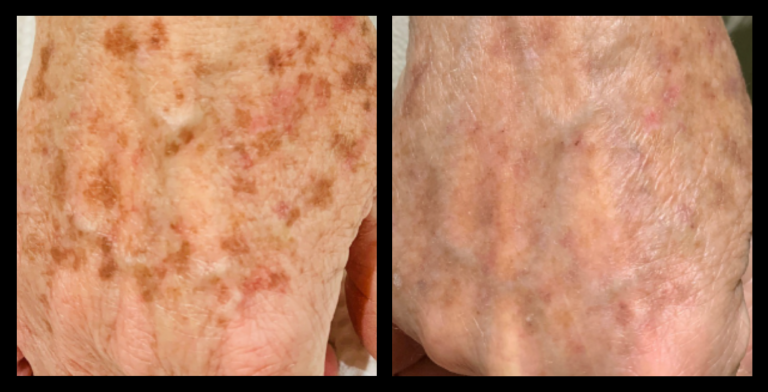 IPL Pigmentation Correction before and after photo showing improved skin clarity and reduced dark spots after 1 treatment. Courtesy of Replenish Skin and Beauty, Beaconsfield, VIC.
