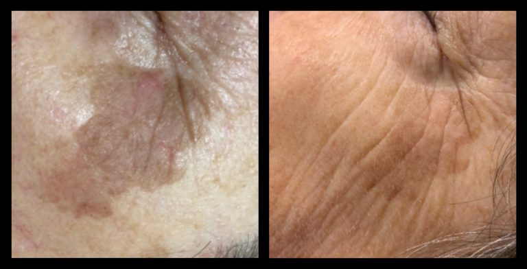Before and after results of IPL Pigmentation Correction showing significant reduction in pigmentation and more even skin tone after 3 treatments. Image courtesy of Sibu Beauty, Crace, ACT.