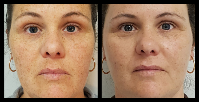 IPL Pigmentation Correction before and after results showing dramatic improvement in skin tone and fading of pigmentation after 4 treatments. Courtesy of Da Vinci Skin Clinic, Bairnsdale, VIC.