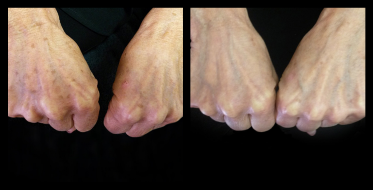 Before and after photo of IPL Pigmentation Correction showing visible reduction in sunspots and pigmentation after 2 treatments. Courtesy of Ella Baché, Batemans Bay, NSW.