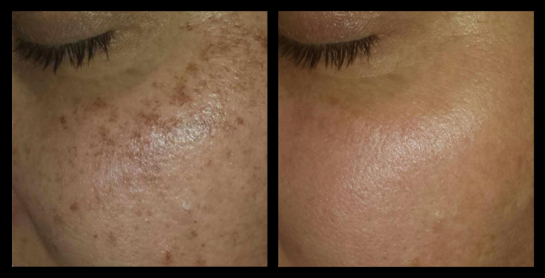 IPL Pigmentation Correction before and after image showing noticeable reduction in pigmentation and clearer skin after 1 treatment. Courtesy of Boutique of Cosmetic Dermatology, Varsity Lakes, QLD.