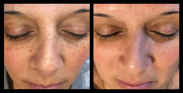 IPL Pigmentation Correction before and after showing reduced dark spots and brighter skin tone after 1 treatment. Courtesy of Glow Skin + Body, Doveton, VIC.