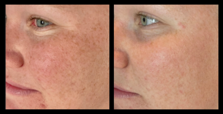 Before-and-after comparison showing noticeable reduction in pigmentation after one IPL Pigmentation Correction treatment. Skin appears brighter and more even. Results by Beauty Body and Balance, Stockton, NSW.