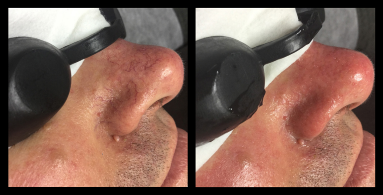 IPL Vascular Therapy before and after – visible reduction in facial redness and broken capillaries after 1 treatment. Performed by Ageless Laser & Skin, Mentone, VIC – expert skin clinic for vascular skin concerns.