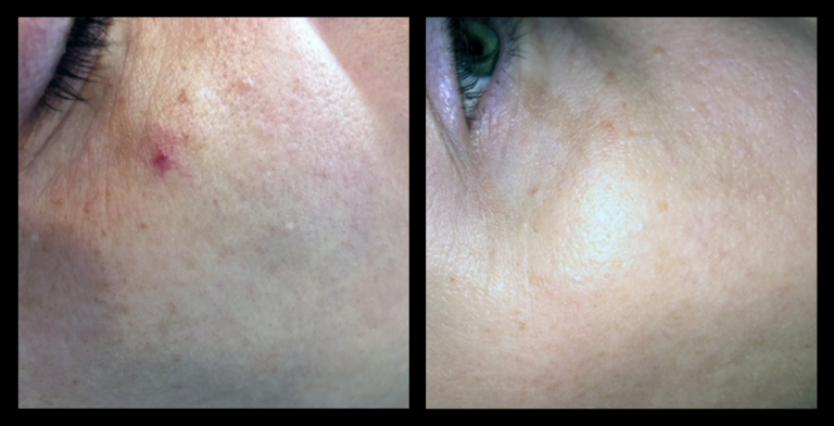 IPL Vascular Therapy before and after results – reduction in facial redness and broken capillaries after 1 treatment at Glow Skin + Body, Doveton, VIC. Non-invasive solution for vascular skin concerns.