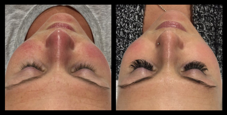 Before and after results of IPL Vascular Therapy treatment showing reduced facial redness and improved skin clarity after one session at SJM Skin Aesthetics, Mornington, VIC.