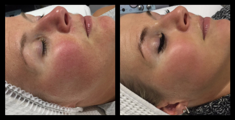 IPL Vascular Therapy before and after results showing visible reduction in facial capillaries and redness after one treatment at SJM Skin Aesthetics, Mornington, VIC.