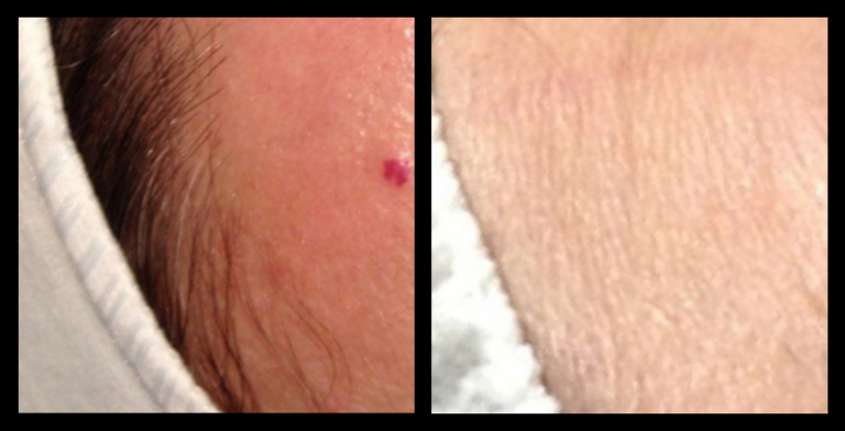 SuperLUX PRO IPL laser machine IPL Vascular Therapy before and after image showing visible reduction in facial redness and broken capillaries after 1 treatment, performed by The Global Beauty Group.