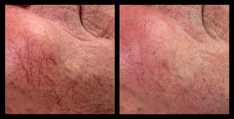 IPL Vascular Therapy before and after image showing visible reduction in facial redness and broken capillaries after 1 treatment at Amie Rose Beauty, Yamba, NSW.
