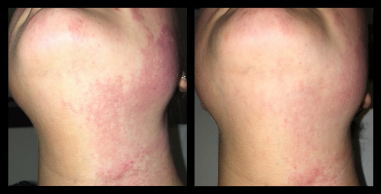 IPL Vascular Therapy before and after results highlighting improved skin clarity and reduced visible blood vessels after 4 treatments at Glow Skin + Body, Doveton, VIC.