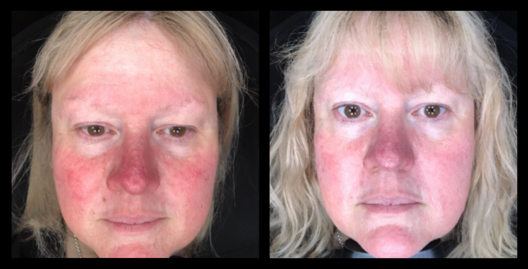IPL Vascular Therapy before and after results showing significant reduction in visible facial veins and redness after 2 treatments at Laser Skin & Body, Wallan, VIC.