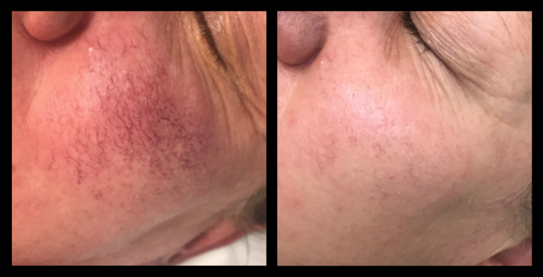 IPL Vascular Therapy before and after comparison showing visible improvement in facial redness and capillaries after 2 treatments at Laser Skin & Body, Wallan, VIC.