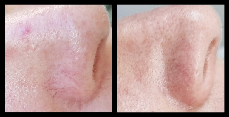 Before and after results of IPL Vascular Therapy showing significant reduction in visible veins and skin redness after 6 treatments at Da Vinci Skin Clinic, Bairnsdale, VIC.