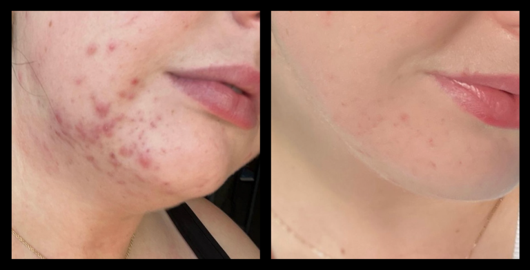 Before and after results from 415nm blue LED light therapy for acne clearing using MediLUX LED. Visible reduction in breakouts, redness, and inflammation, with clearer skin, smoother texture, and a more even complexion.