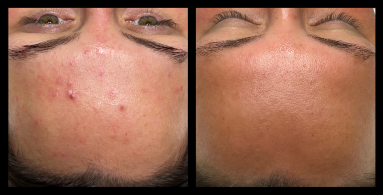 Before and after results from 415nm blue LED light therapy for acne clearing using MediLUX LED. Visible reduction in breakouts, redness, and inflammation, with clearer skin, smoother texture, and a more even complexion.