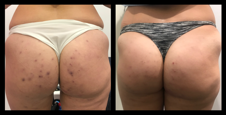 Before and after results from 415nm blue light MediLUX LED light therapy on acne affecting the buttocks. Significant reduction in inflammation, redness, and active breakouts, with visibly clearer and calmer skin.