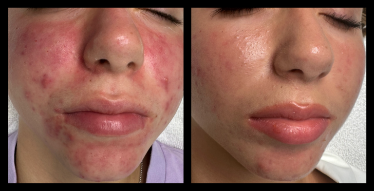 Before and after results from 415nm blue LED light therapy for acne clearing using MediLUX LED. Visible reduction in breakouts, redness, and inflammation, with clearer skin, smoother texture, and a more even complexion.