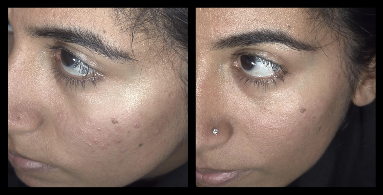 Before and after results from 415nm blue LED light therapy using MediLUX on mild acne across the cheeks. Subtle improvements in skin clarity, reduced redness, and a more balanced, even complexion.